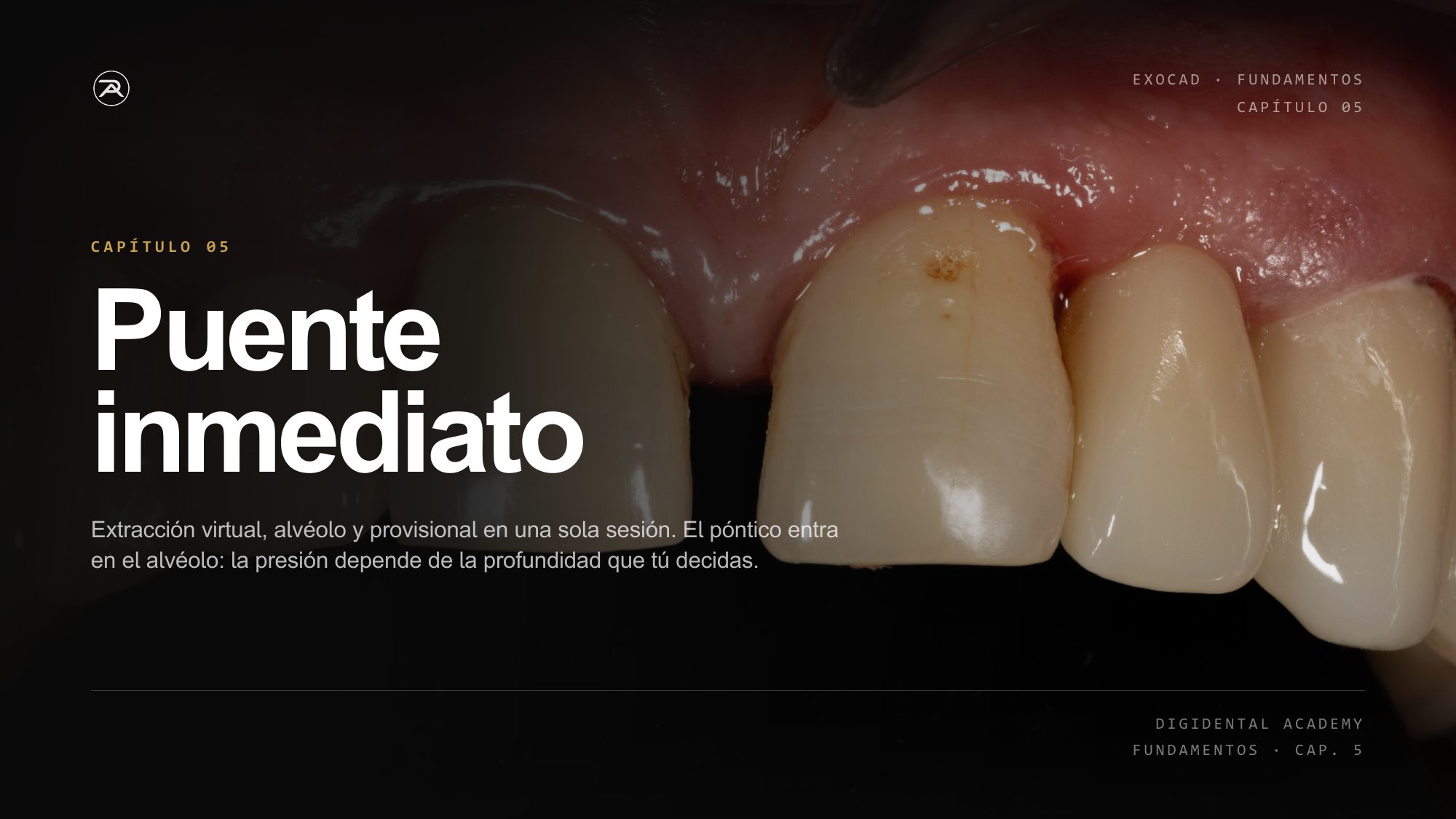 Cap. 5 · Puente inmediato